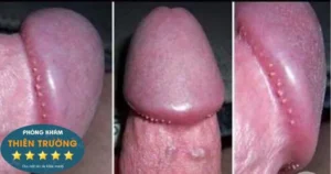 Hình ảnh: Sùi mào gà