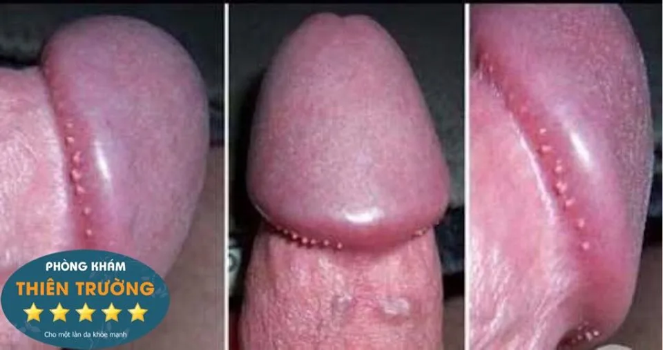 Hình ảnh: Bệnh sùi mào gà