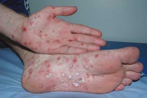 trieu-chung-cua-benh-giang-mai-1