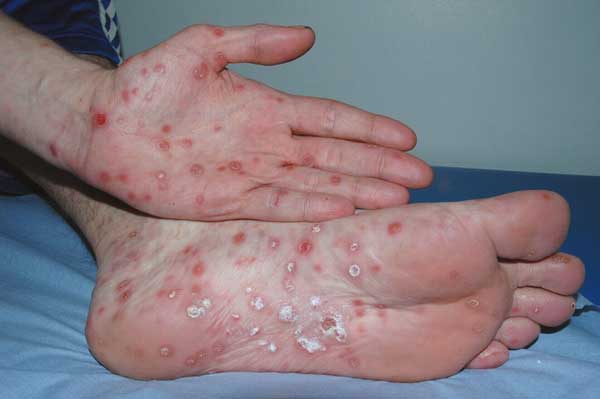 trieu-chung-cua-benh-giang-mai-1