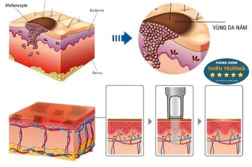 Mô hình cơ chế thực hiện khi thực hiên trẻ hóa da bằng LASER TONING Hình ảnh: Mô hình cơ chế thực hiện khi thực hiên trẻ hóa da bằng LASER TONING