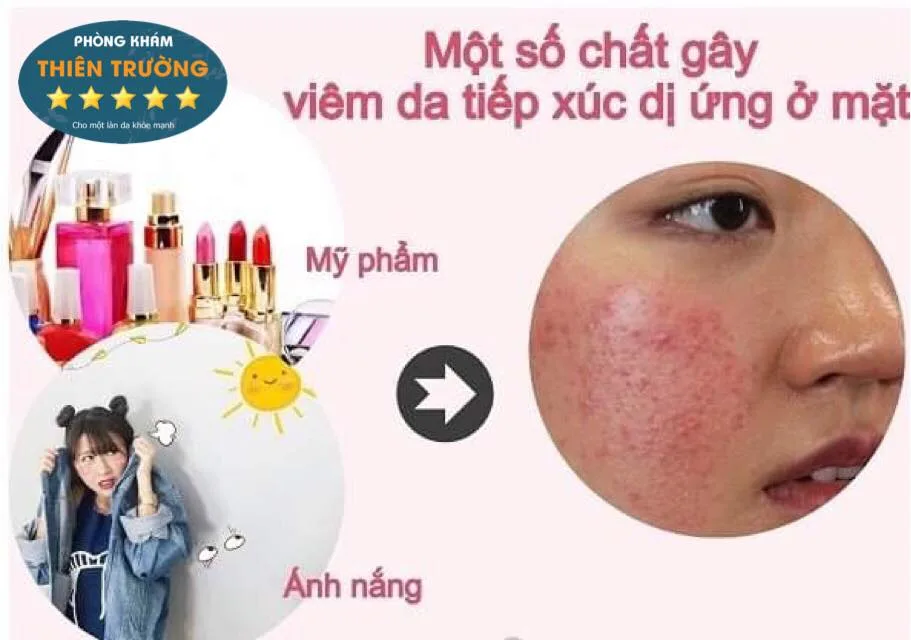 Hình ảnh: Một số chất gây viêm da tiếp xúc.