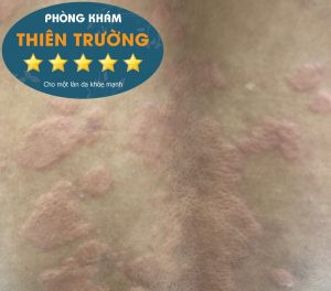 noi-me-day Hình ảnh: Tuyệt đối không gãi khi bị nổi mề đay