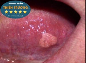 Hình ảnh: sùi mào gà