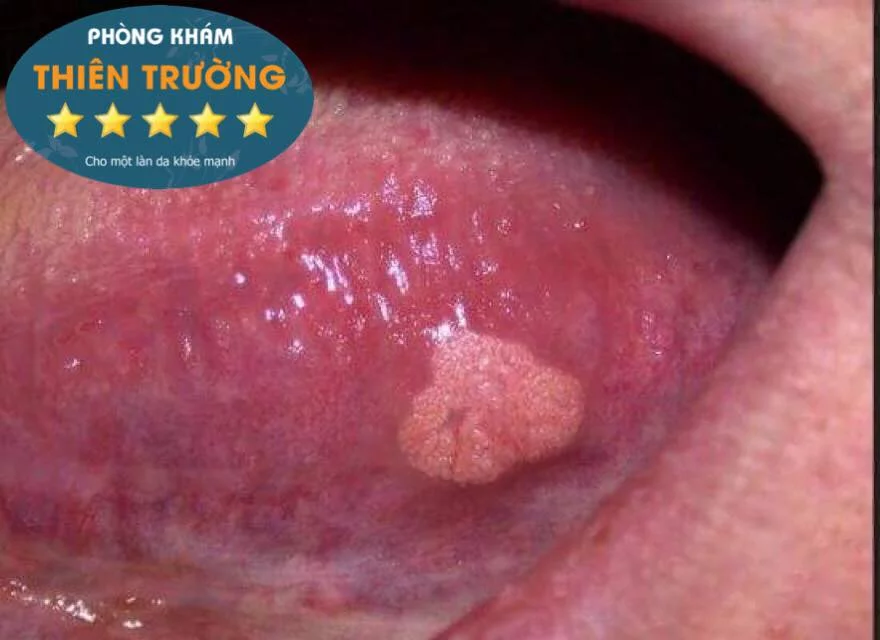 Hình ảnh: sùi mào gà