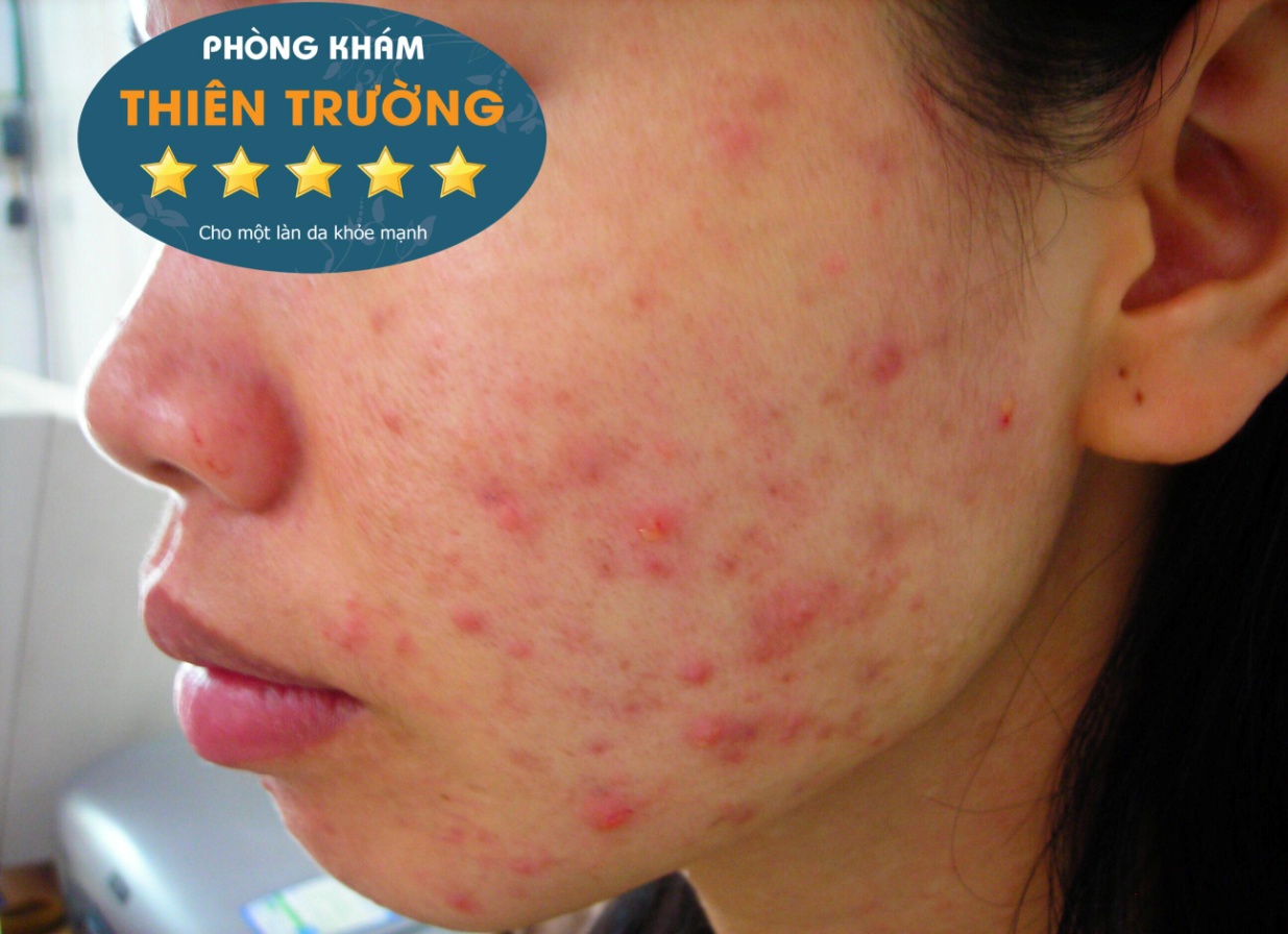 Hình ảnh: Khách hàng bị mụn mủ Hình ảnh: Khách hàng bị mụn mủ