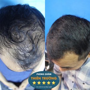 Hình ảnh : trước và sau điều trị