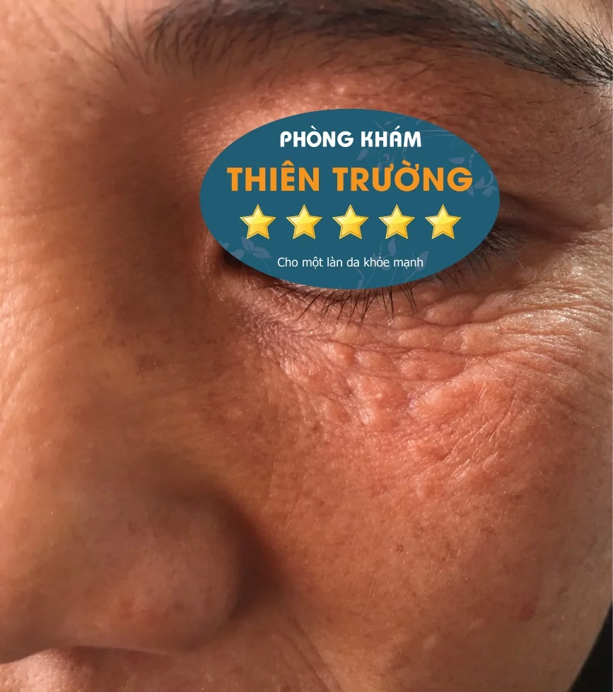 Mụn thịt thường xuất hiện ở vùng mắt, trán, gò má