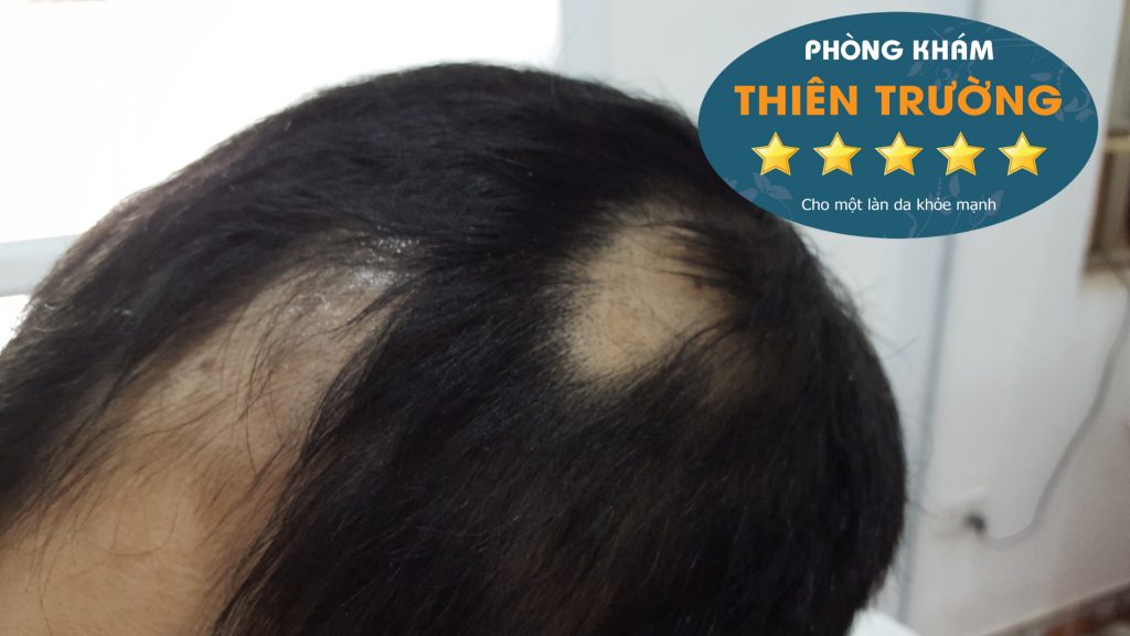 Hình ảnh: Rụng tóc.