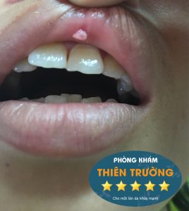 Hình ảnh u nhú sùi