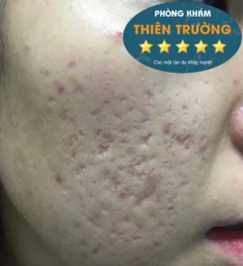 Hình ảnh : sẹo lõm