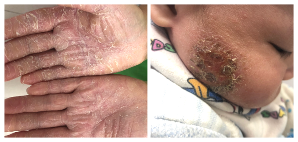 VIÊM DA CƠ ĐỊA, CHÀM  SỮA