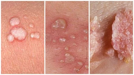 Hình ảnh: Sùi mào gà