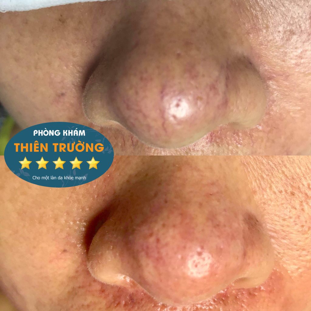 Hình ảnh: Trước và sau khi hỗ trợ điều trị giãn mao mạch ở mũi