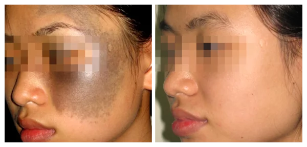 BỚT NÂU XANH