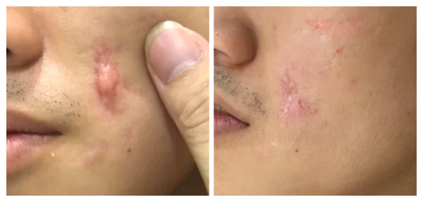 SẸO LỒI