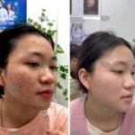 Hình ảnh : Trước và sau điều trị mụn .