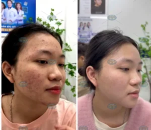 Hình ảnh : Trước và sau điều trị mụn .