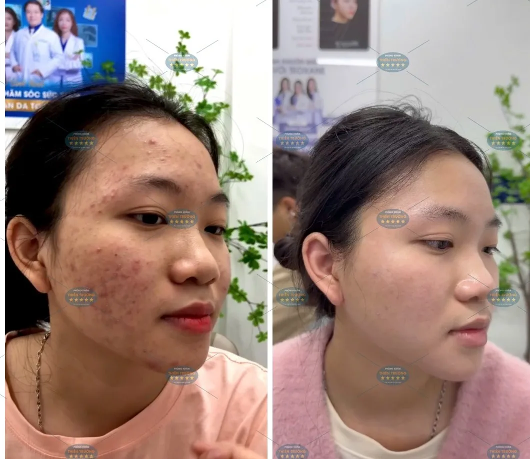 Hình ảnh : Trước và sau điều trị mụn .