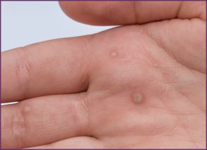 Vị trí dễ bị hạt cơm mụn cóc