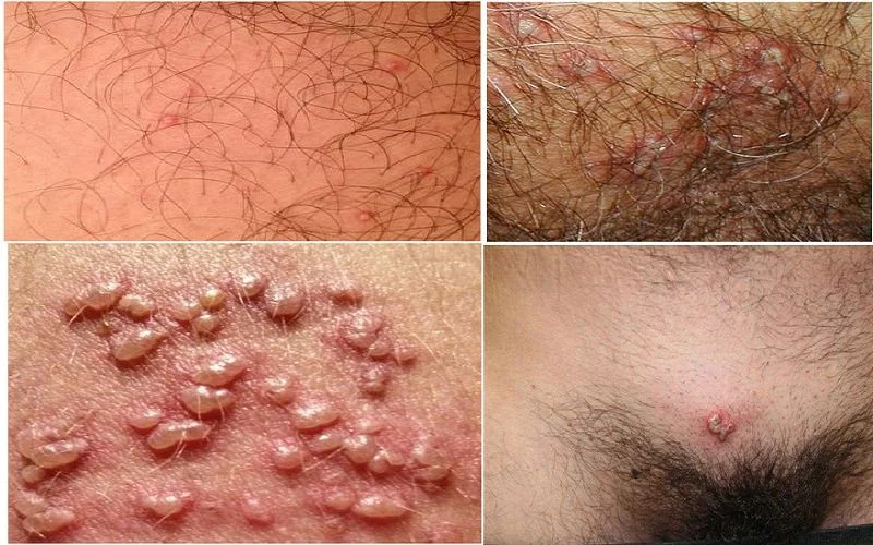 Vị trí dễ bị hạt cơm mụn cóc