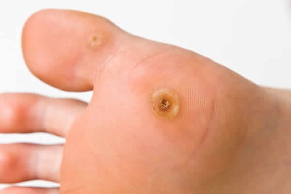 Nguyên nhân có hạt cơm mụn cóc do đâu