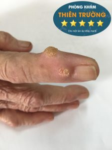 Hình ảnh mụn hạt cơm ở tay