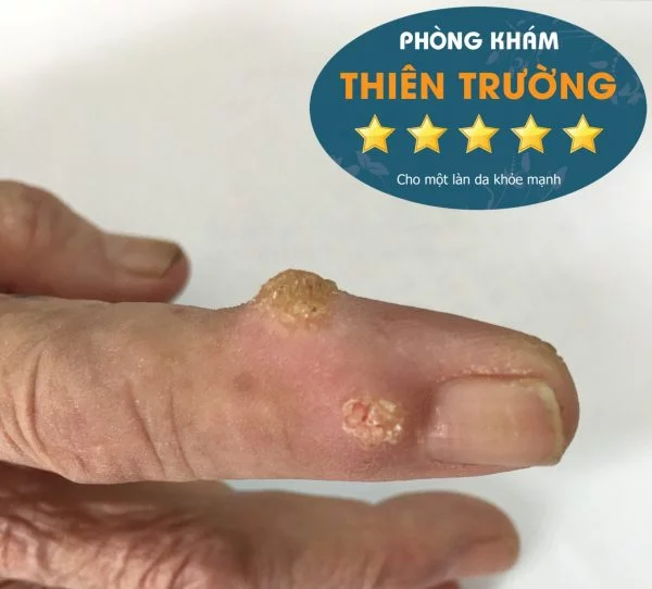 Hình ảnh: Hạt cơm thông thường