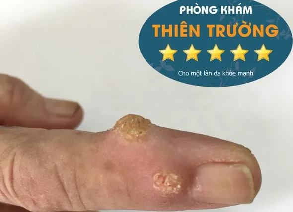 Hình ảnh: Hạt cơm mọc ở tay