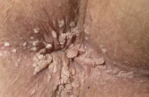 Hình ảnh: Bệnh sùi mào gà ở hậu môn