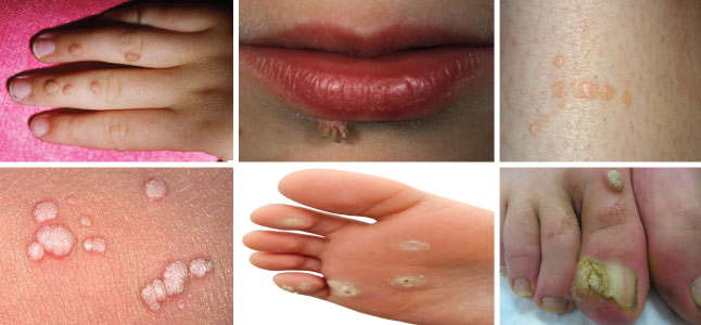 Hình ảnh: Biểu hiện mọc hạt cơm mụn cóc phổ biến nhất Hình ảnh: Biểu hiện mọc hạt cơm mụn cóc phổ biến nhất