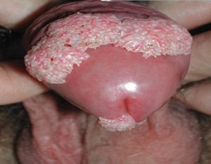 Các thông tin cần thiết về bệnh sùi mào gà ở nam giới3.1