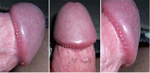 Hình ảnh: Sùi mào gà ở nam giới