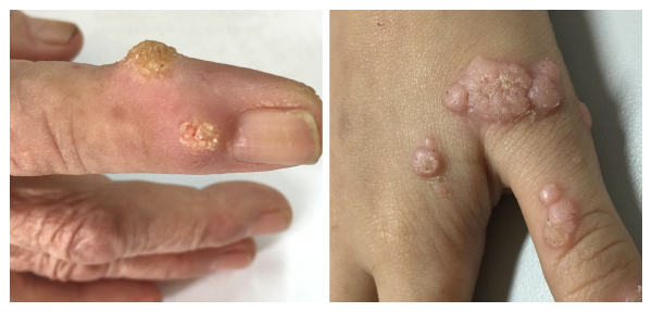 MỤN CÓC HẠT CƠM