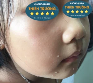 Hình ảnh: U mềm lây xuất hiện ở trẻ em
