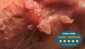 Hình ảnh: Sùi mào gà mọc trên cơ thể Hình ảnh: Sùi mào gà mọc trên cơ thể