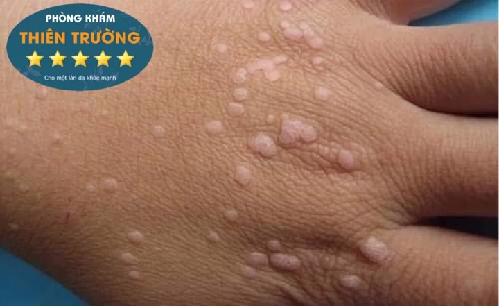 Hình ảnh: Hạt cơm phẳng ở mu bàn tay.