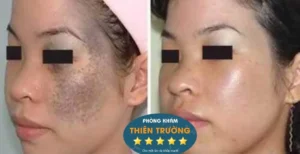 Hình ảnh: Khách hàng hỗ trợ điều trị bớt sắc tố