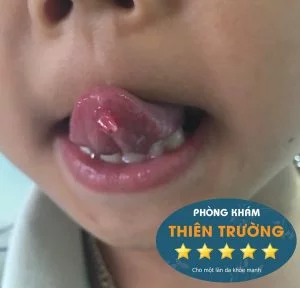 Hình ảnh: sùi mào gà ở trẻ em