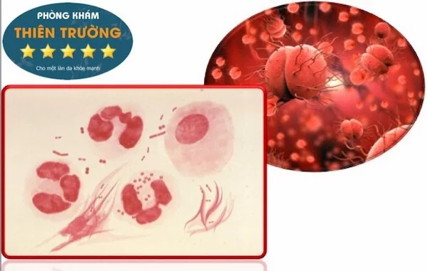 Bệnh lậu thường gặp ở cả nam và nữ