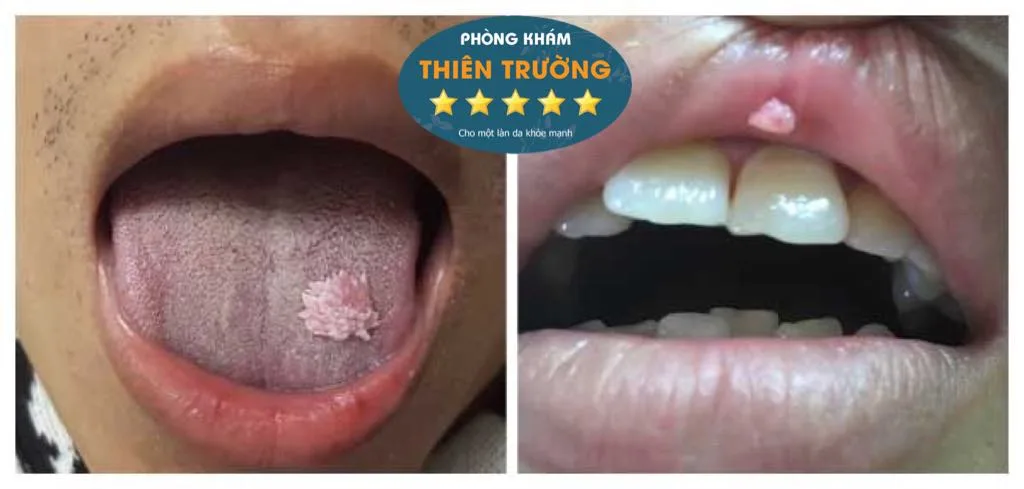 Hình ảnh: sùi mào gà ở miệng