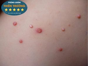 Hình ảnh: Cận ảnh u mềm lây