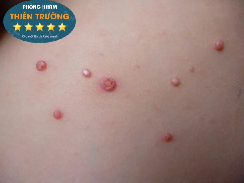 Hình ảnh: Cận ảnh u mềm lây