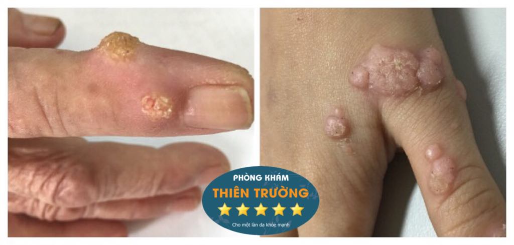 Hình ảnh: Hạt cơm mụn cóc mọc ở tay