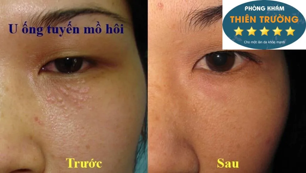 Hình ảnh: U ống tuyến mồ hôi ở mắt