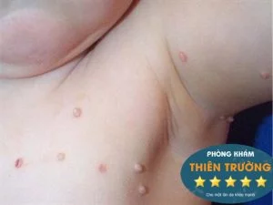 Hình ảnh: u mềm lây vùng ngực, nách