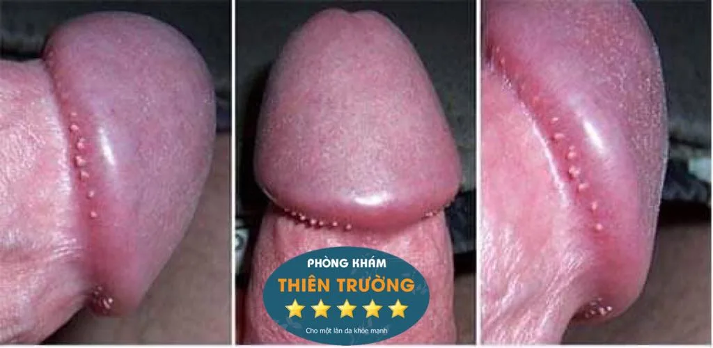 Hình ảnh: Sùi mào gà 