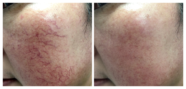 GIÃN MAO MẠCH MÁ