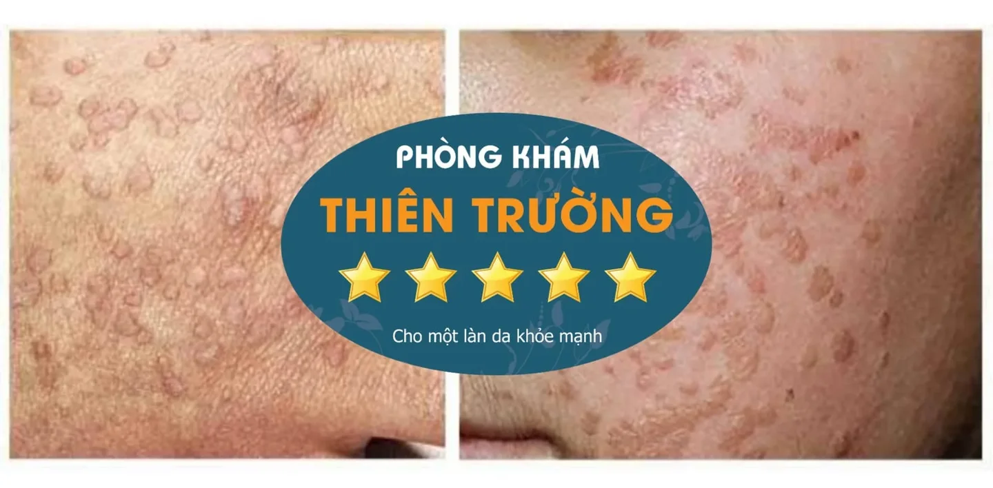Hình ảnh: Hạt cơm phẳng 