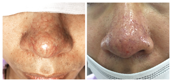 GIÃN MAO MẠCH MŨI